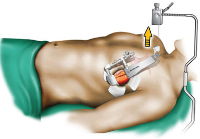 Koltuk Altı Ameliyatları Kimlere Uygulanabilir? Koltuk Altı Ameliyatları Kimlere Uygulanabilir?