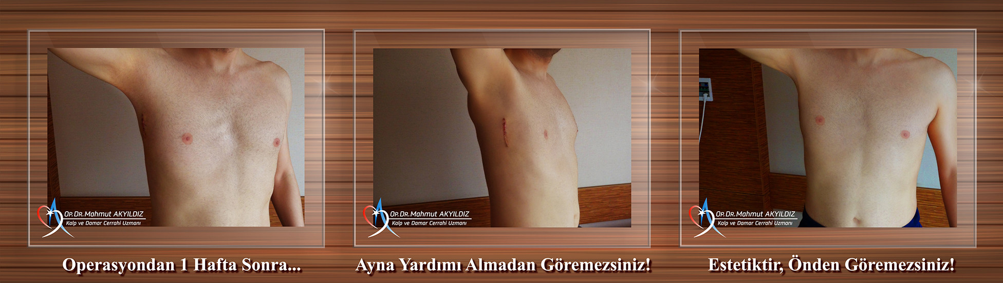 Koltuk Altı Kalp Ameliyatları