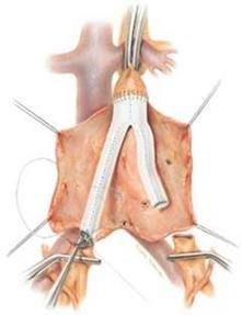 Aort Cerrahisi Aort Cerrahisi