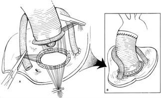 Aort Cerrahisi Aort Cerrahisi
