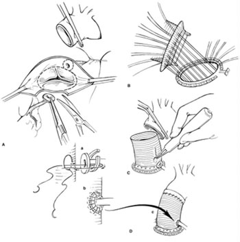 Aort Cerrahisi Aort Cerrahisi