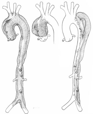 Aort Cerrahisi Aort Cerrahisi