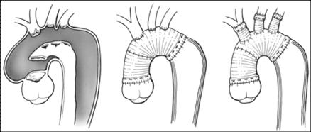 Aort Cerrahisi Aort Cerrahisi