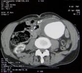 Aort Cerrahisi Aort Cerrahisi