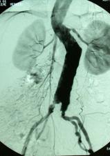 Aort Cerrahisi Aort Cerrahisi