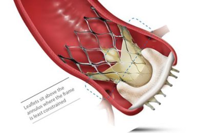 CoreValve (Medtronic)