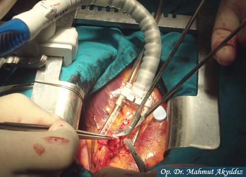 Çalışan Kalpte Bypass